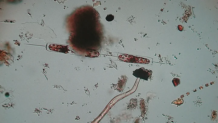 Latest ‘flesh-eating bacteria’ outbreaks around the world
